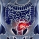 Atezolizumab-with-or-without-cobimetinib-vs-regorafenib-for-previously-treated-metastatic-colorectal-cancer-IMblaze370