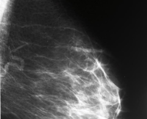 ASCO-2019-breast-cancer-TNBC-MBC-ABC-ASCO19-MONALEESA-7-TRINITI-1-FAKTION-TBCRC030-NeoSTOP-ETNA-GeparOLA-KRISTINE-PREDIX-CLEOPATRA-HERITAGE-SOPHIA-NALA-IMpassion-130