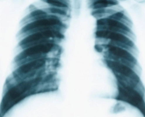 ASCO-2019-lung-cancer-NSCLC-ASCO19-SCLC-mesothelioma-KEYNOTE-189-KEYNOTE-001-IMpower150-MYSTIC-LCMC3-Lung-MAP-S1400G-S1400I-Flaura-CALGB-30901-DETERRED-COMPASS-