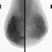 Capivasertib-combined-with-paclitaxel-improves-survival-of-metastatic-triple-negative-breast-cancer-patients-e1582170747234