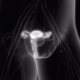 Olaparib-plus-Bevacizumab-as-Maintenance-Therapy-in-Ovarian-Cancer