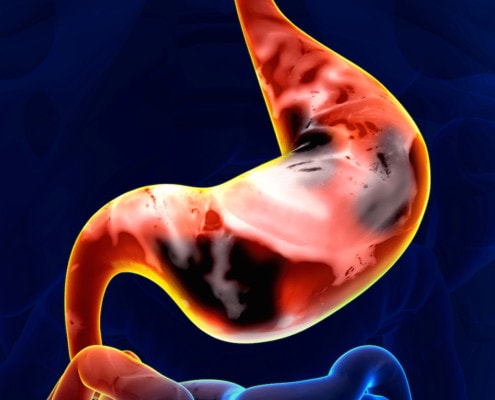 gastric-adenocarcinoma-ramucirumab-cyramza-pembrolizumab-nivolumab-trastuzumab-dmmr-msi-her2-vegf-vegfr-gastric-cancer-gej-gastroesophageal-junction-cancer-pd-1-pd-l1-eli-lilly-lilly
