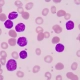 Lower-risk-MDS-patients-benefit-from-novel-drug-imetelstat