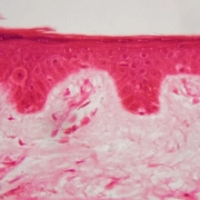 One-year-data-of-bimekizumab-versus-ustekinumab-for-plaque-psoriasis-in-the-BE-VIVID-trial