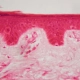 One-year-data-of-bimekizumab-versus-ustekinumab-for-plaque-psoriasis-in-the-BE-VIVID-trial
