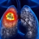 First-liquid-biopsy-for-NSCLC-to-receive-FDA-approval
