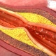 psoriasis-biologics-may-help-reduce-coronary-plaque
