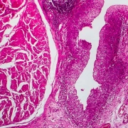 The-emerging-role-of-targeted-therapy-in-advanced-urothelial-carcinoma