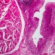 The-emerging-role-of-targeted-therapy-in-advanced-urothelial-carcinoma