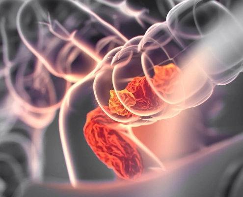 Effect-of-prior-therapy-on-BRAF-V600E-mutant-metastatic-colorectal-cancer