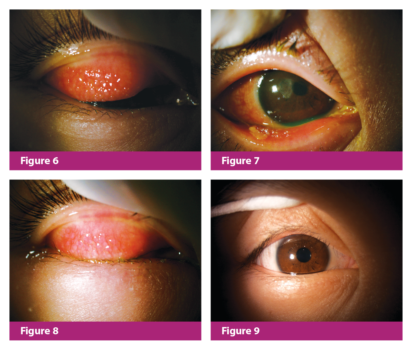 Figure 6. Right upper eyelid before treatment Figure 7. Right eye before treatment Figure 8. Right upper eyelid, after 1.5 months of 0.1% CsA and tapering corticosteroid treatment Figure 9. Right eye, after 2 years of 0.1% CsA maintenance treatment Figure 6. Right upper eyelid before treatment Figure 7. Right eye before treatment Figure 8. Right upper eyelid, after 1.5 months of 0.1% CsA and tapering corticosteroid treatment Figure 9. Right eye, after 2 years of 0.1% CsA maintenance treatment