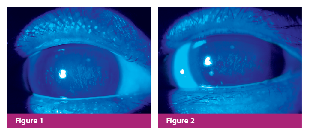 Figure 1. Corneal staining of the right eye before topical CsA treatment Figure 2. Corneal staining of the left eye before topic CsA treatment Figure 1. Corneal staining of the right eye before topical CsA treatment Figure 2. Corneal staining of the left eye before topic CsA treatment
