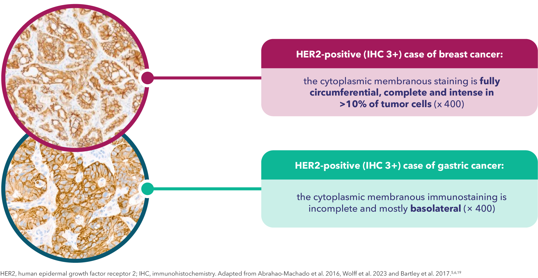 MHK-DAI-2024135 Website #3-04 Figure 2. Examples of HER2-positive (IHC 3+) specimens of breast and gastric cancer